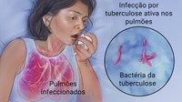 Tuberculose afeta 70 mil brasileiros todos os anos; doença matou 4.426 pessoas no País em 2016